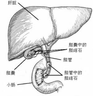 胆囊需切除怎么办